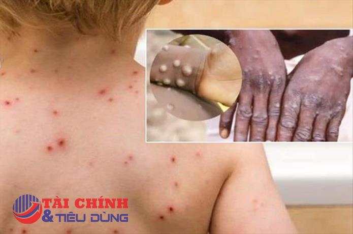 WHO kêu gọi cộng đồng chung tay ngăn chặn đậu mùa khỉ trở thành đại dịch toàn cầu như COVID-19