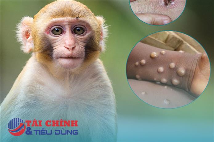 Ghi nhận ca bệnh đậu mùa khỉ đầu tiên tại TP.HCM