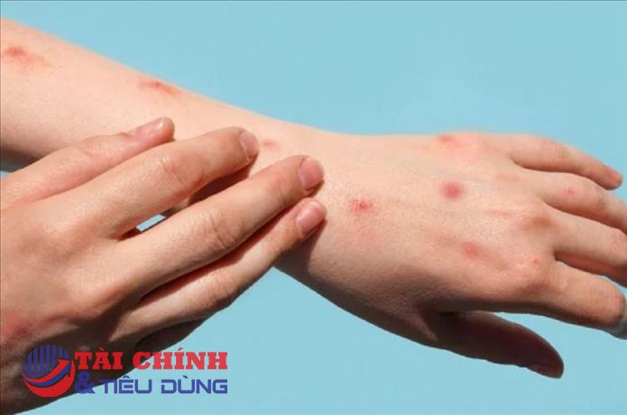 Ngành Y tế đã xây dựng các kịch bản phòng chống dịch bệnh đậu mùa khỉ